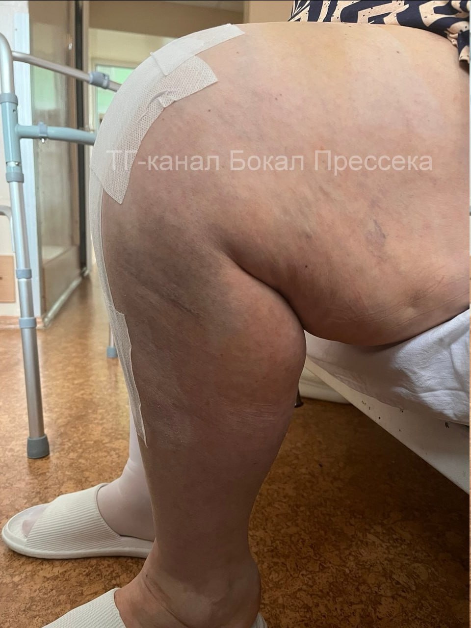 «Она обещала похудеть» — 56-летнюю нижегородку весом больше 120 килограммов с разрушенным коленным суставом спасли врачи