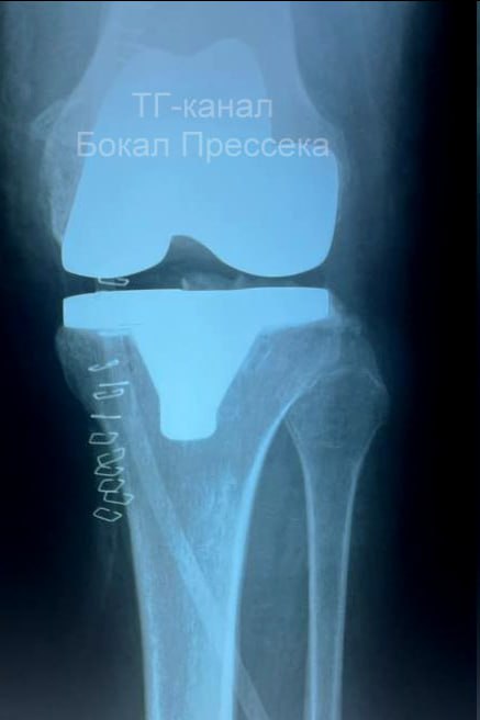 «Она обещала похудеть» — 56-летнюю нижегородку весом больше 120 килограммов с разрушенным коленным суставом спасли врачи «Она обещала похудеть» — 56-летнюю нижегородку весом больше 120 килограммов с разрушенным коленным суставом спасли врачи