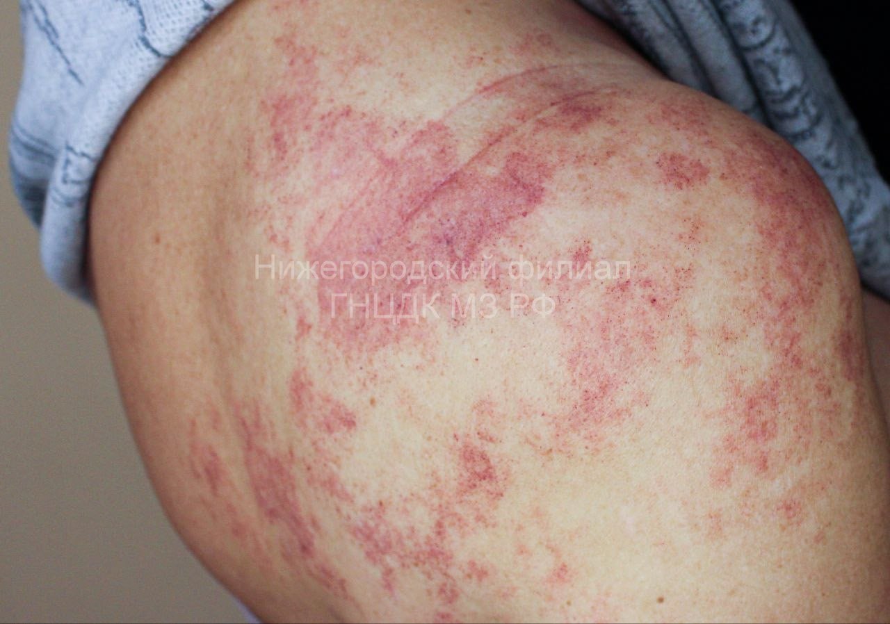 Нижегородские врачи спасли пациентку с последствиями укуса гадюки