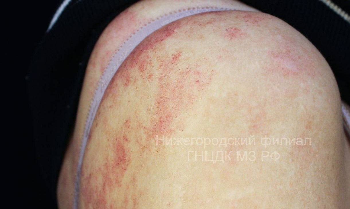 Нижегородские врачи спасли пациентку с последствиями укуса гадюки Нижегородские врачи спасли пациентку с последствиями укуса гадюки