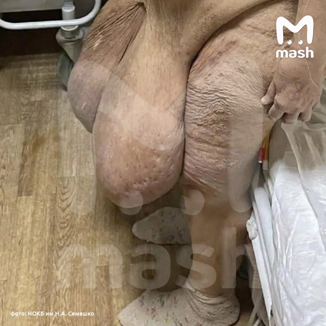 Гигантское образование на животе вырезали у жительницы Нижегородской области — больше пяти лет у неё росло патологическое скопление лимфы Гигантское образование на животе вырезали у жительницы Нижегородской области — больше пяти лет у неё росло патологическое скопление лимфы