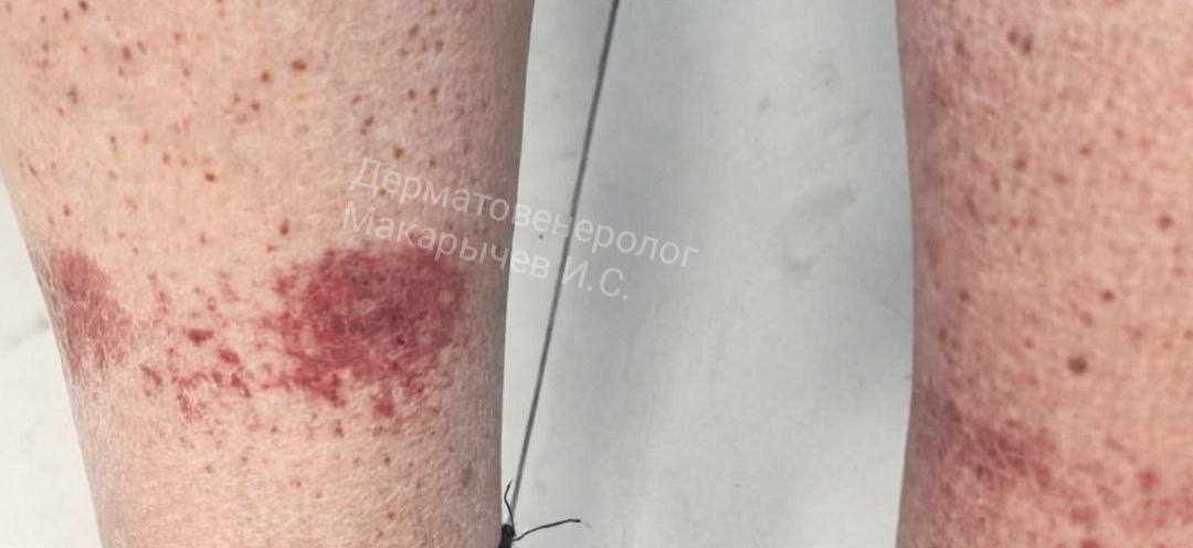 У нижегородца полопались капилляры на ногах из-за постоянной уборки снега возле дома