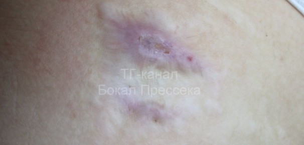 Хотели “подышать” отваром ромашки, а получили келоидный рубец