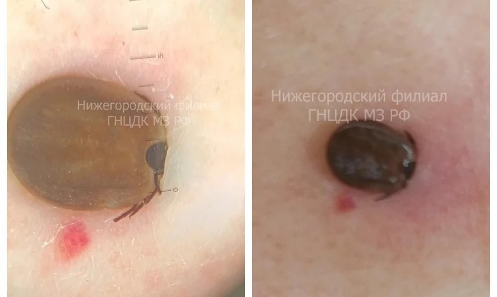 Клеща обнаружили среди родинок на теле нижегородки при осмотре у врача